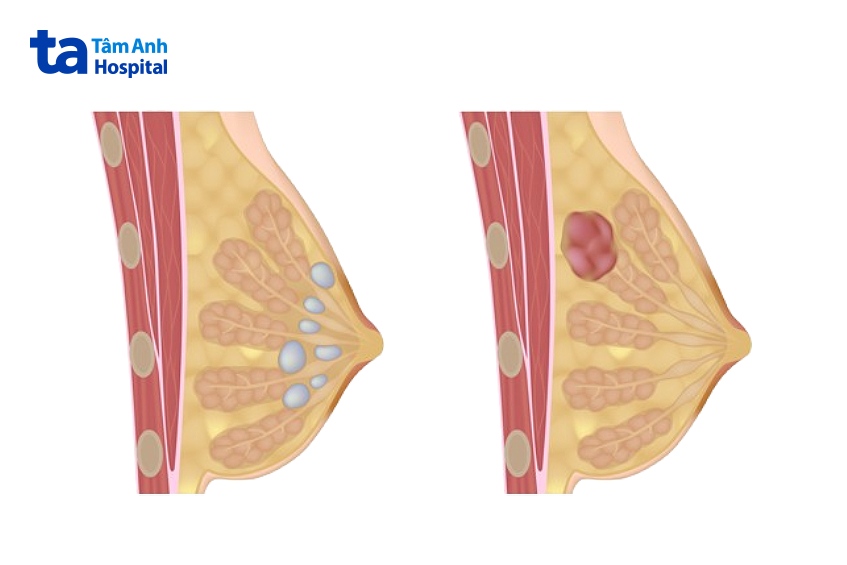 bệnh u xơ vú có nguy hiểm không