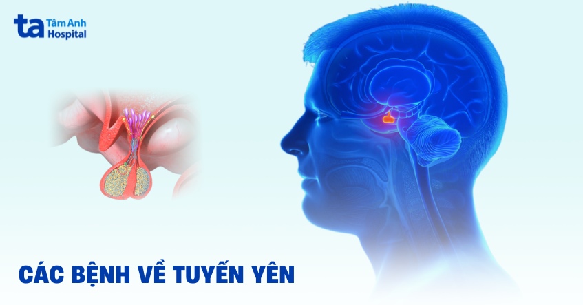 10 bệnh về tuyến yên thường gặp và đối tượng nguy cơ mắc bệnh