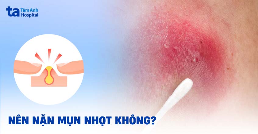 Bị mụn nhọt có nên nặn không? Liệu có biến chứng gì không?