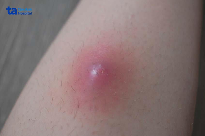 bị mụn nhọt khi nào nên gặp bác sĩ