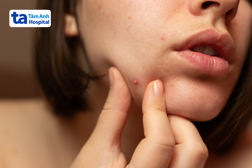 Khi có mụn trứng cá nên làm gì?