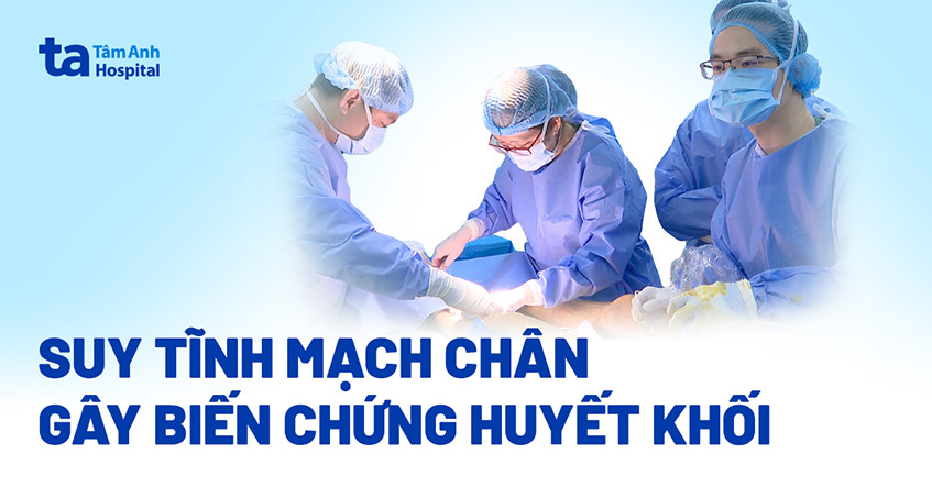 Biến chứng huyết khối sau 20 năm suy giãn tĩnh mạch
