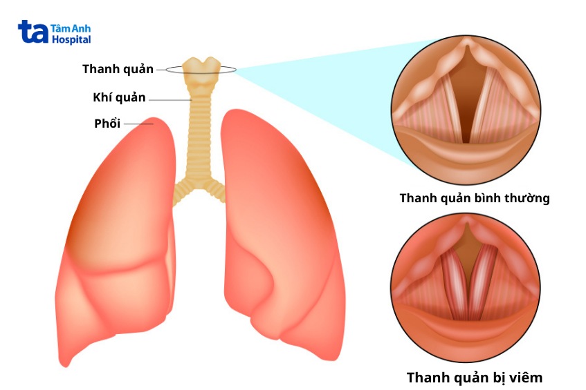biến chứng viêm thanh quản