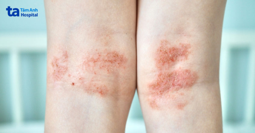 Biểu hiện viêm da cơ địa ở chân