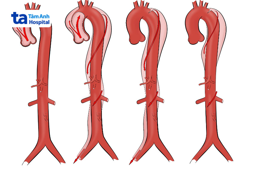Bóc tách động mạch chủ được phát hiện nhờ siêu âm Doppler động mạch chủ