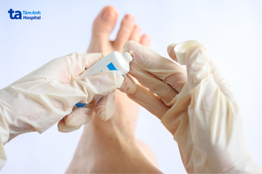 Bôi thuốc điều trị nấm móng ngón chân