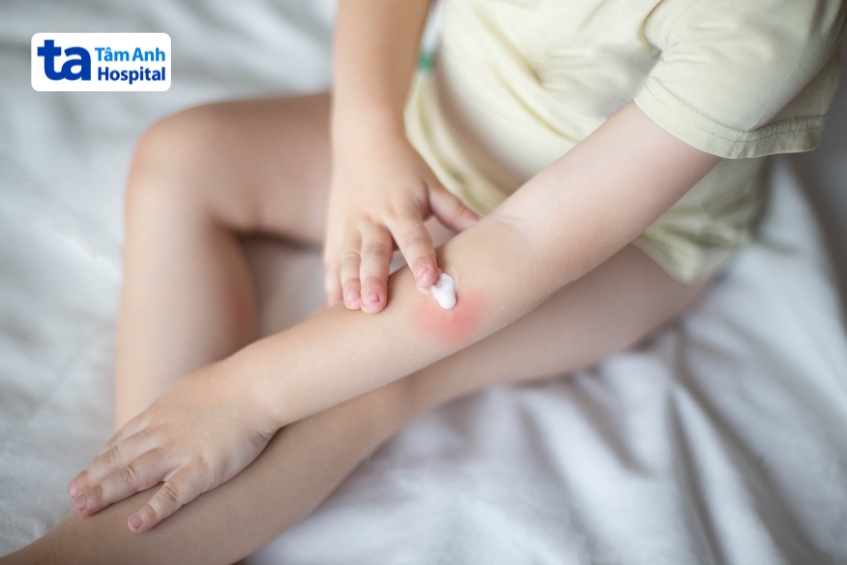 Bôi thuốc trị bỏng theo chỉ định của bác sĩ
