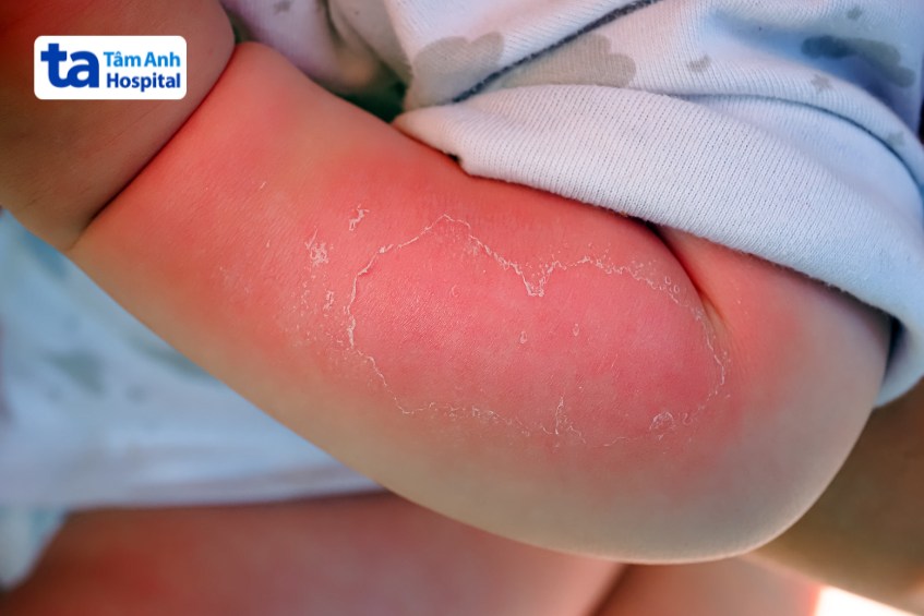 Bỏng nước sôi khiến da sưng đỏ, rát, đau đớn