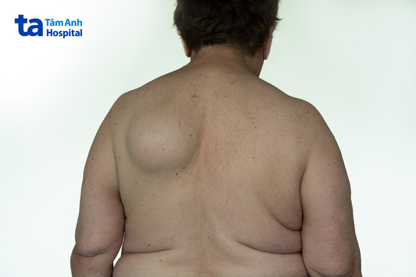 bướu mỡ xuất hiện ở lưng