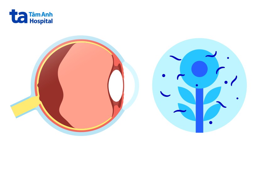 các đốm đen trong mắt người bệnh