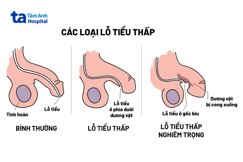 Các loại lỗ tiểu thấp