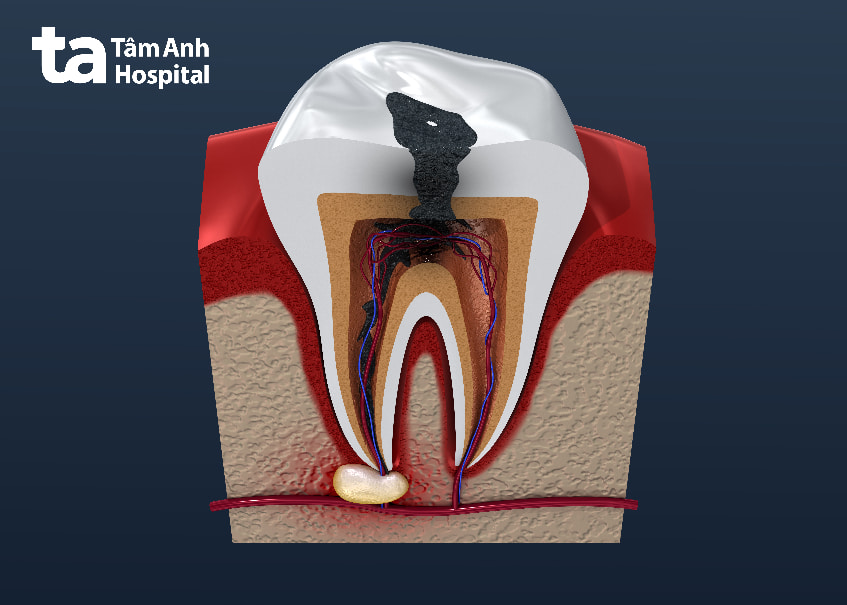 Tại sao cách trị sâu răng tại nhà không hiệu quả?