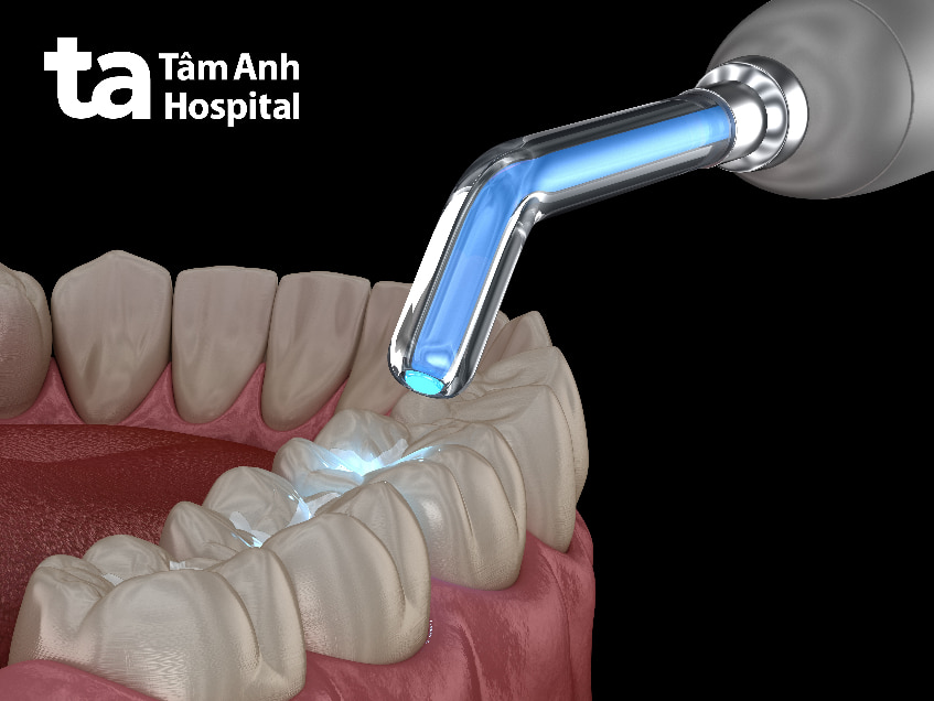 Phương pháp điều trị sâu răng