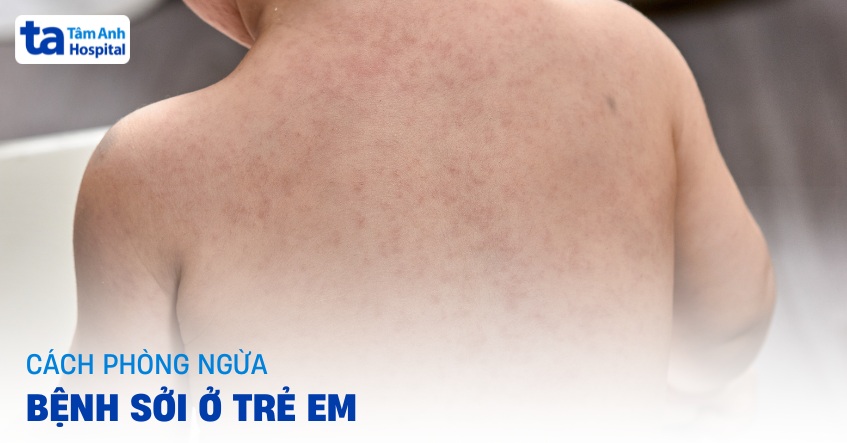 Nhấn vào ảnh để phóng to Cách phòng ngừa bệnh sởi ở trẻ em