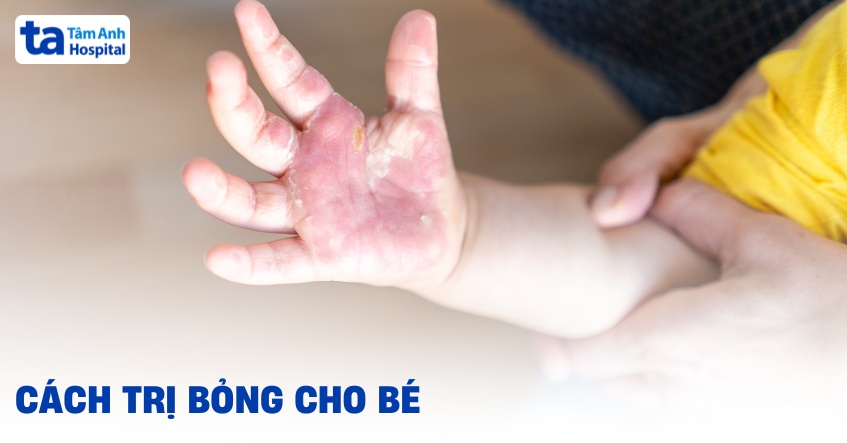 Cách trị bỏng cho bé an toàn, hiệu quả