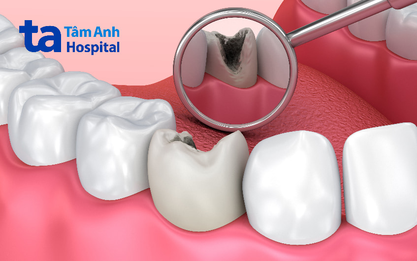 Cách trị sâu răng tại nhà có hiệu quả, an toàn không?