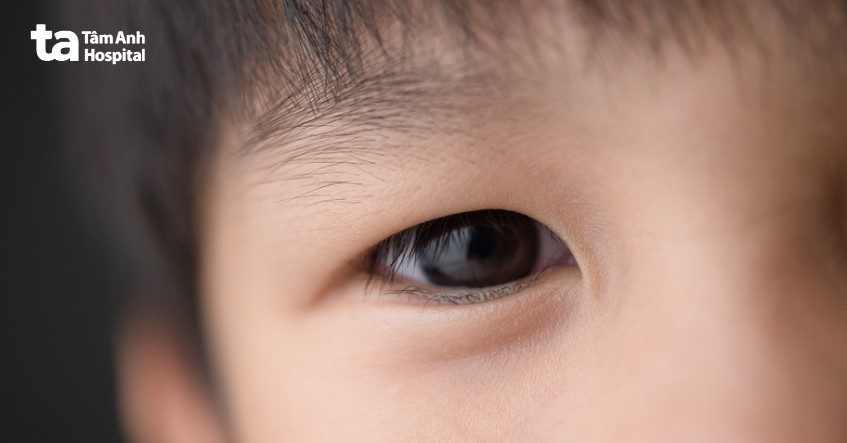cẩn thận nếu có bất thường ở mắt trẻ
