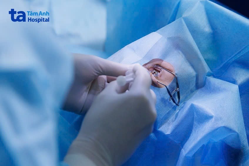 cắt dịch kính trị phù hoàng điểm