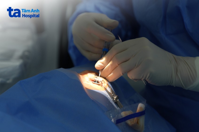 cắt dịch kính trị viêm màng bồ đào