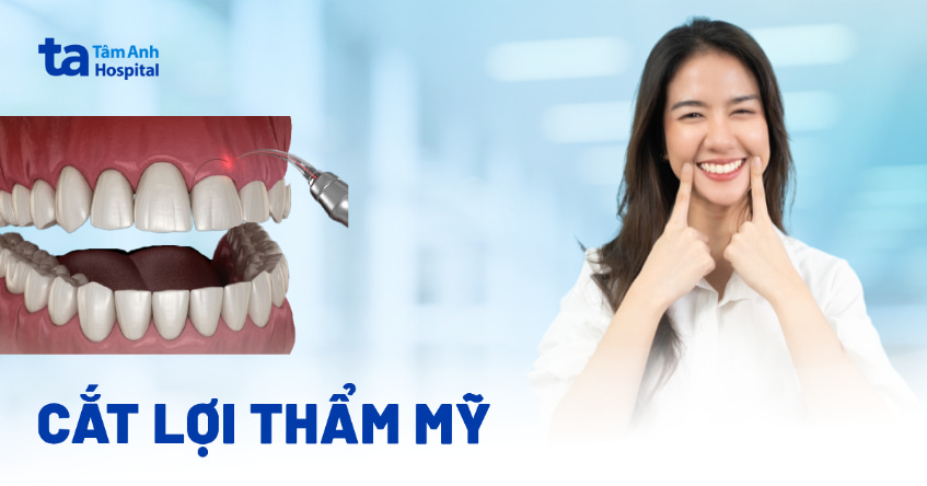 cắt lợi thẩm mỹ