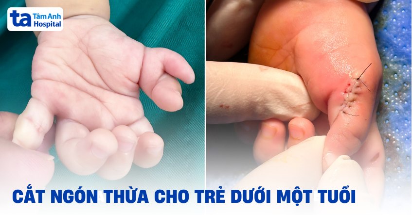 Cắt ngón thừa cho trẻ dưới một tuổi