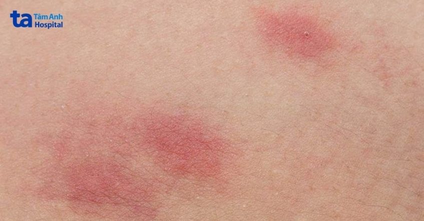 chấm đỏ trên da là dấu hiệu của các bệnh lý
