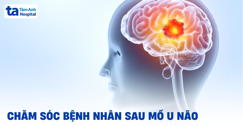 Kế hoạch chăm sóc bệnh nhân sau mổ u não nên như thế nào?