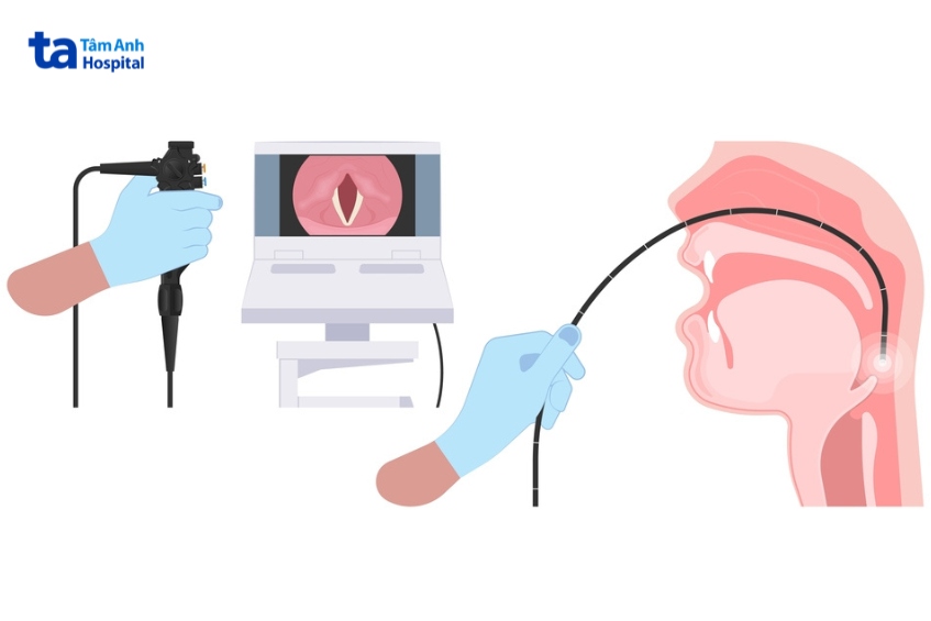 chẩn đoán viêm thanh quản