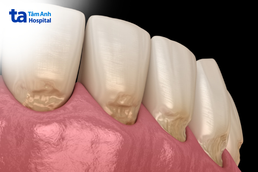 mòn cổ chân răng