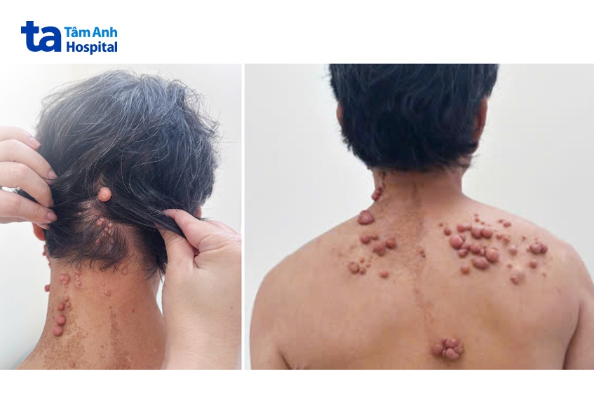 chi chít khối u nhiều kích cỡ tại vùng lưng đầu cổ của bệnh nhân