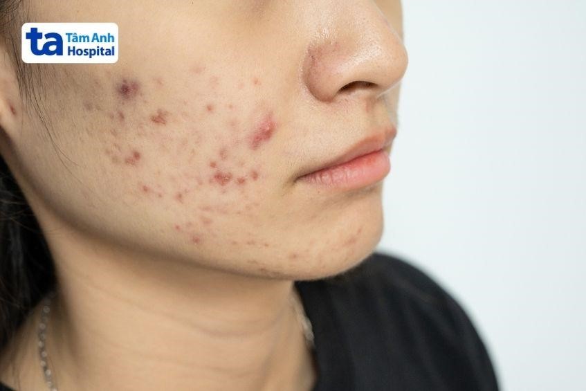 Chỉ định và chống chỉ định của thuốc Tetracyclin 500mg