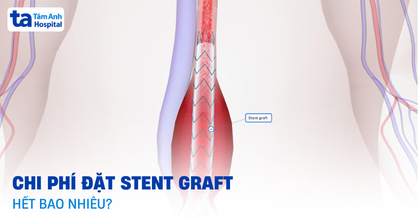 Chi phí đặt stent graft giá bao nhiêu tiền? Có được bảo hiểm?
