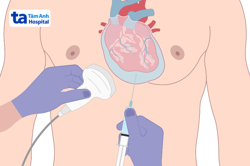 Chọc hút dịch màng tim giúp loại bỏ tích tụ dịch trong màng tim