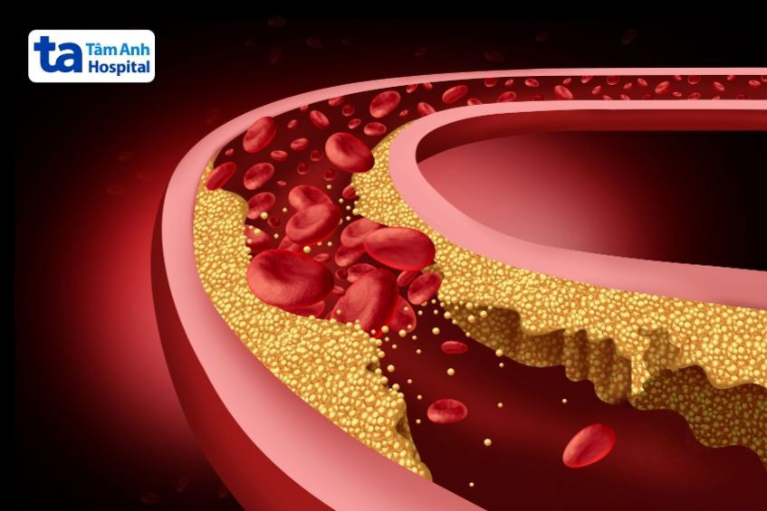 Cholesterol cao làm tăng mảng bám tích tụ ở thành động mạch gây cản trở lưu thông máu