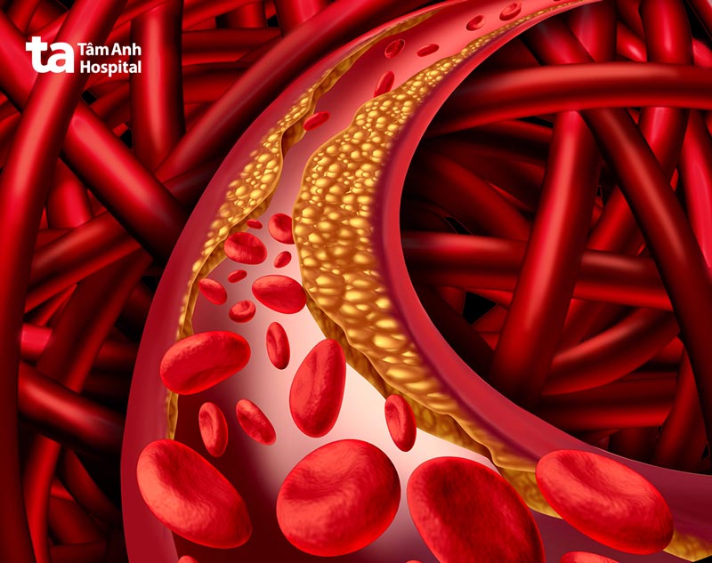 Cholesterol trong máu cao gây tích tụ mảng xơ vữa