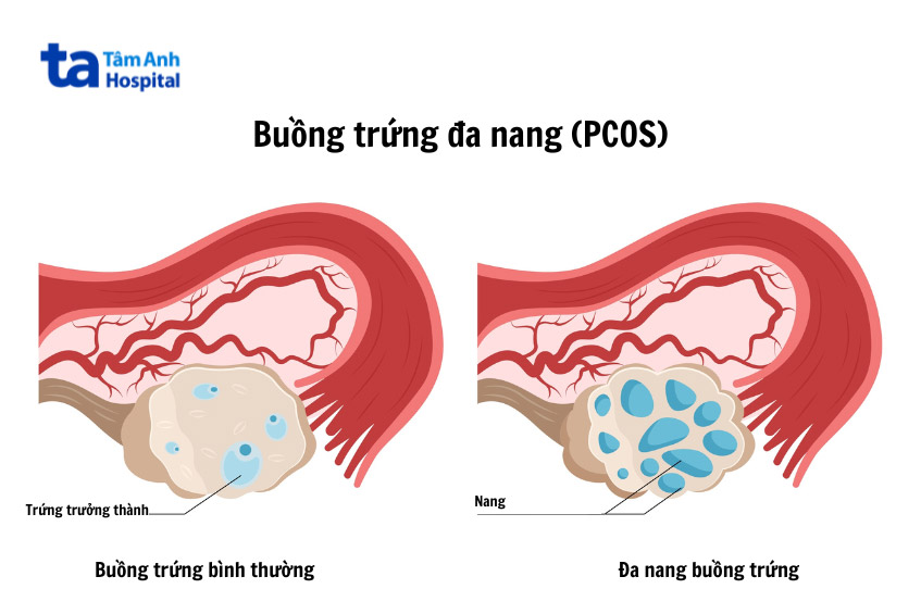 Chữa trị buồng trứng đa nang