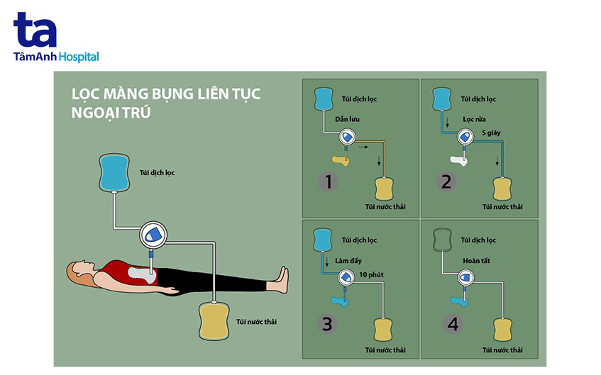 Cơ chế lọc màng bụng liên tục ngoại trú