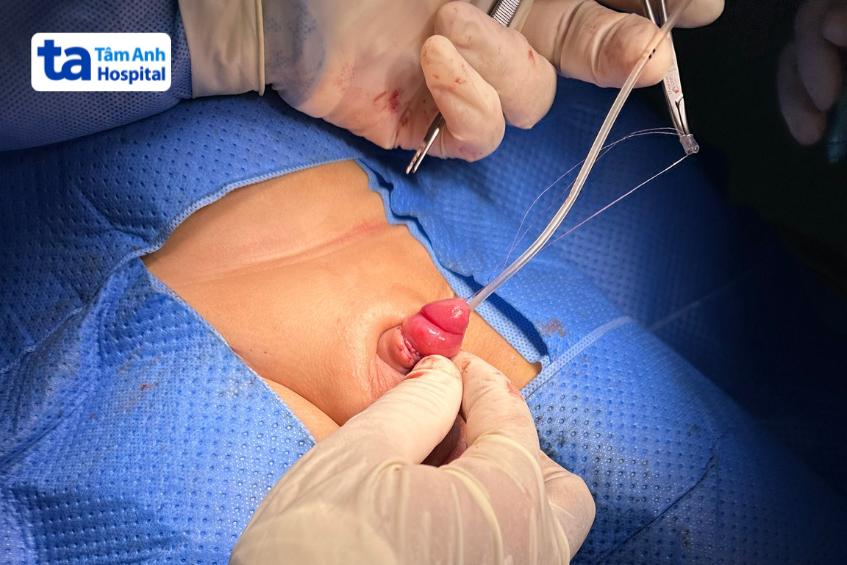 Cố định vị trí dương vật cho trẻ