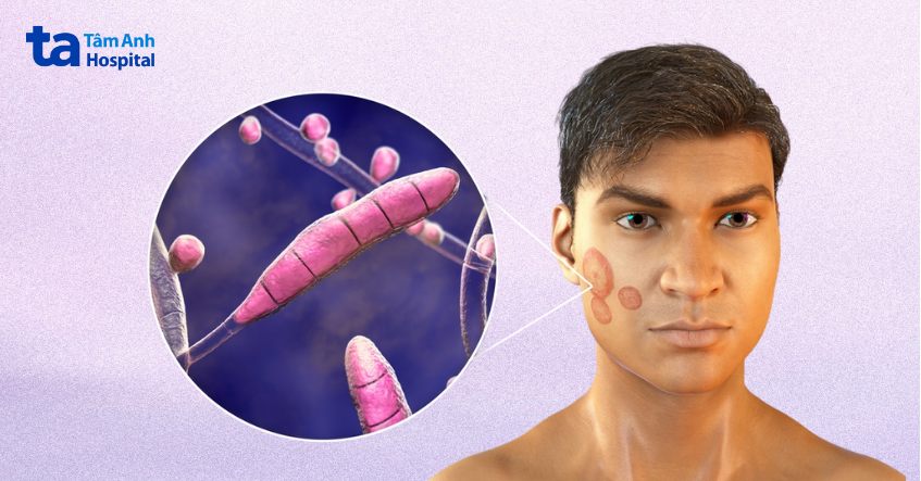 có nhiều chủng loại nấm da mặt khác nhau