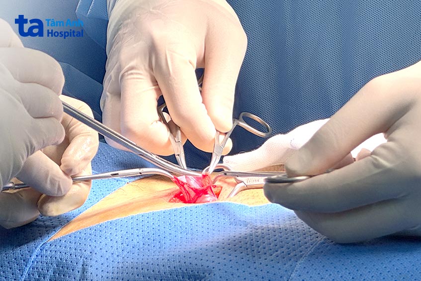 Cổ túi thoát vị lớn khiến phúc mạc và các tạng trong ổ bụng có thể chui xuống dưới vùng bẹn