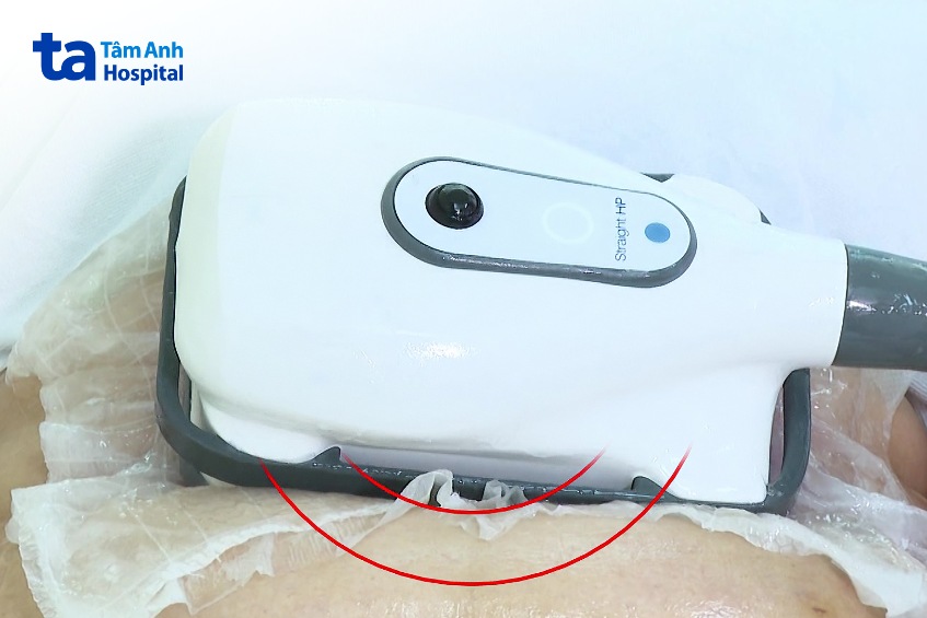 công nghệ đông hủy mỡ dùng cơ chế nhiệt lạnh