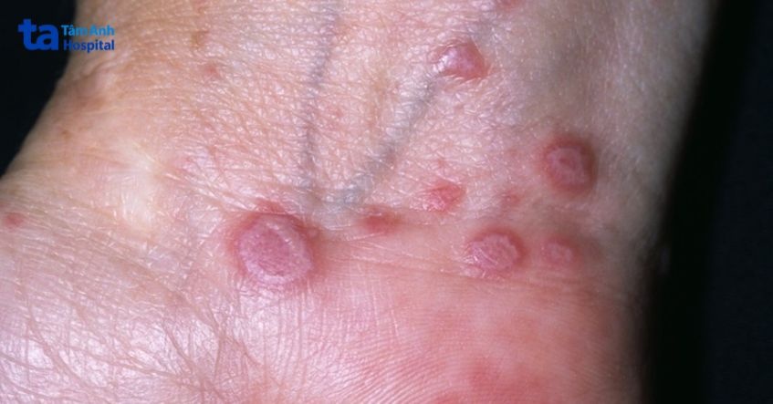 da bị nổi đốm đỏ có nguy hiểm không