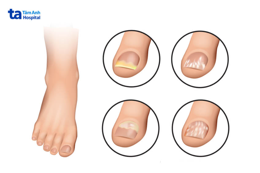 Dấu hiệu bị nấm móng