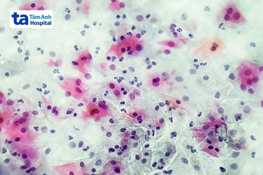 dấu hiệu của nhiễm trùng âm đạo