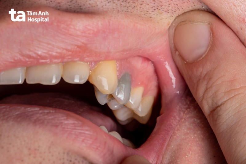 dấu hiệu răng chết tủy