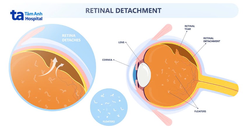 dấu hiệu thoái hóa dịch kính