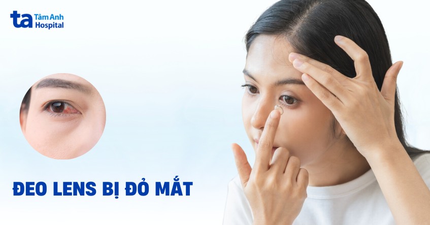 Đeo lens bị đỏ mắt có sao không? Tại sao và lưu ý khi sử dụng