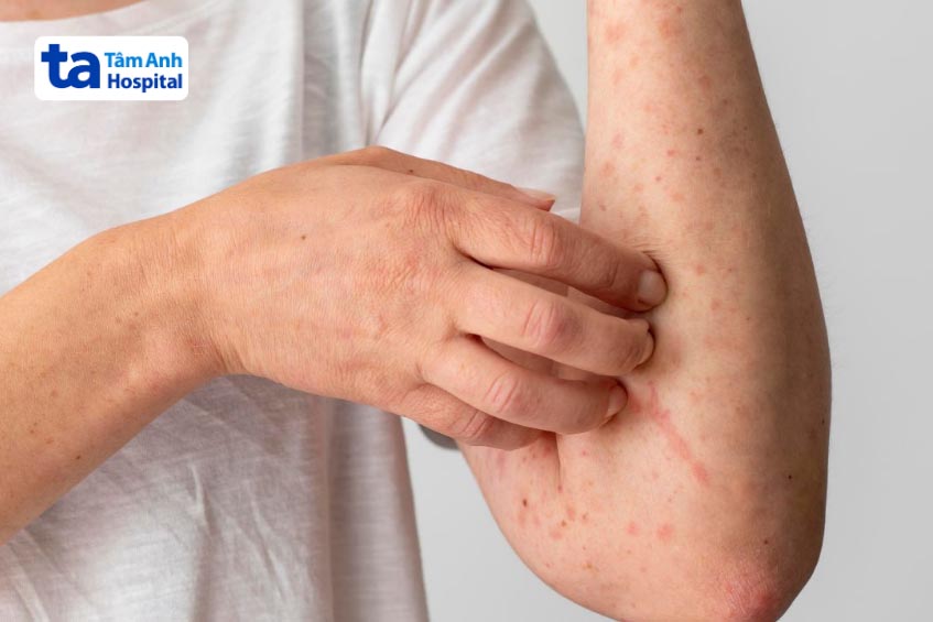 Dị ứng khi tiêm vắc xin phế cầu
