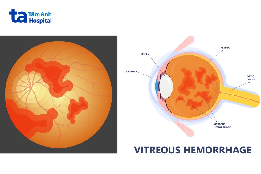 dịch kính tổn thương gây xuất huyết