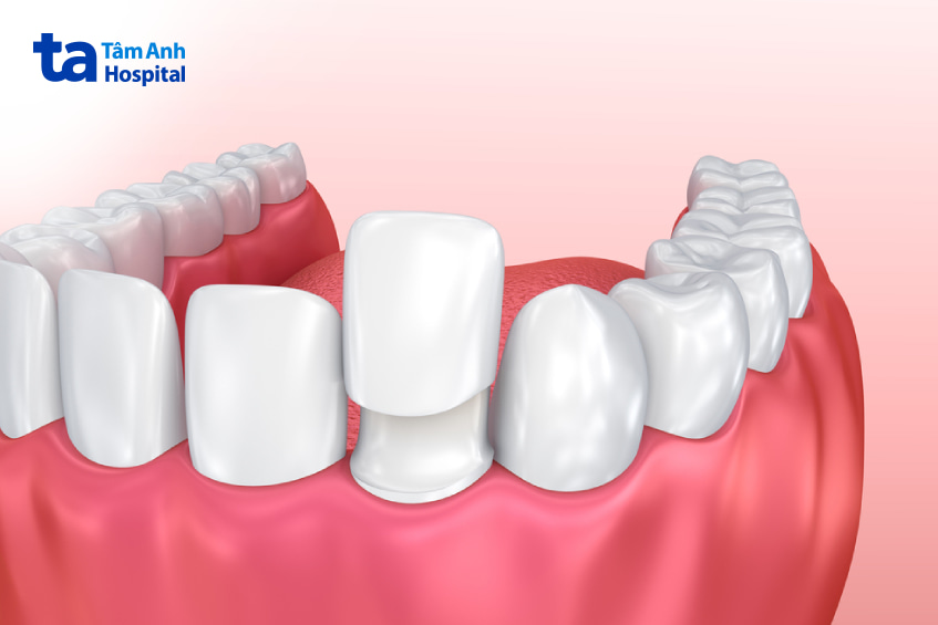 Cách điều trị mòn cổ chân răng